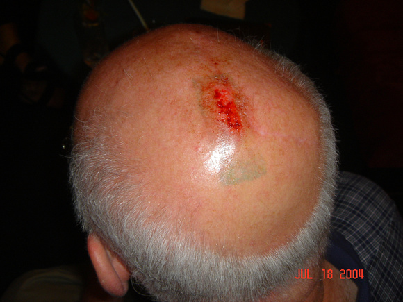 Greg's injured scalp